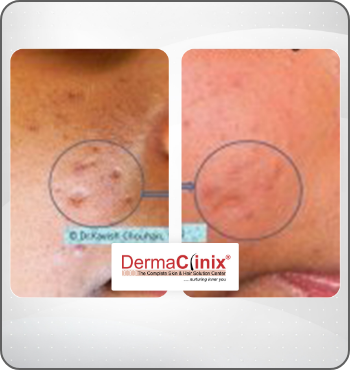 hair transplant results