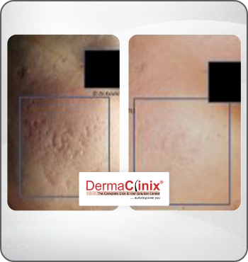 hair transplant results