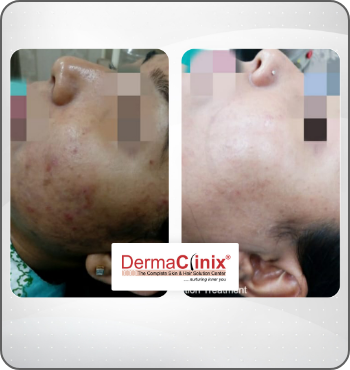 hair transplant results