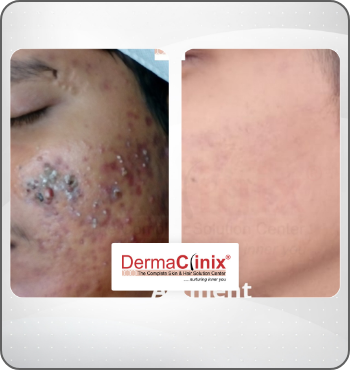 hair transplant results