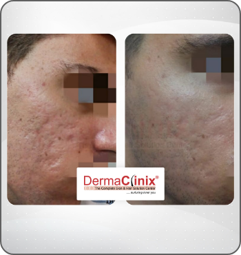 hair transplant results