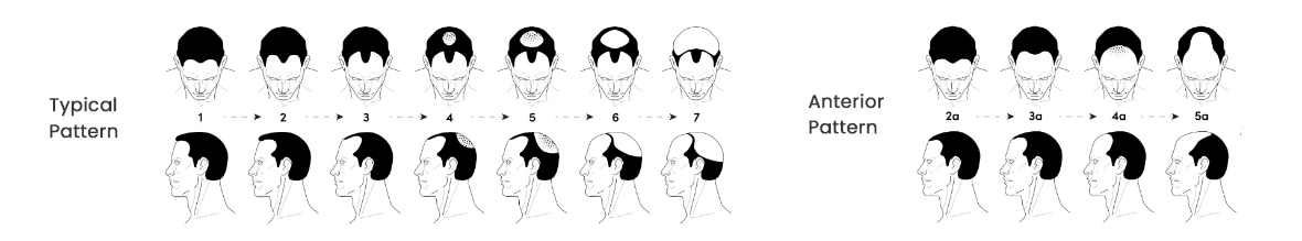 Best hair transplant in delhi graft