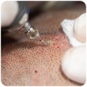 Best hair transplant in delhi