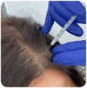 Best hair transplant in delhi