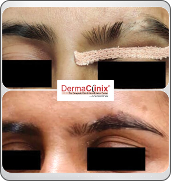 hair transplant results