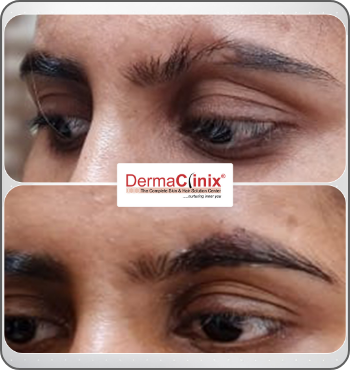 hair transplant results