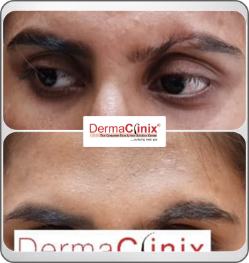 hair transplant results