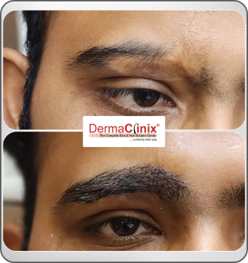 hair transplant results