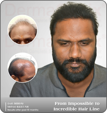 hair transplant results