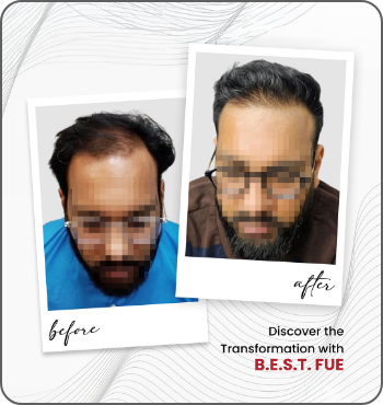 hair transplant results
