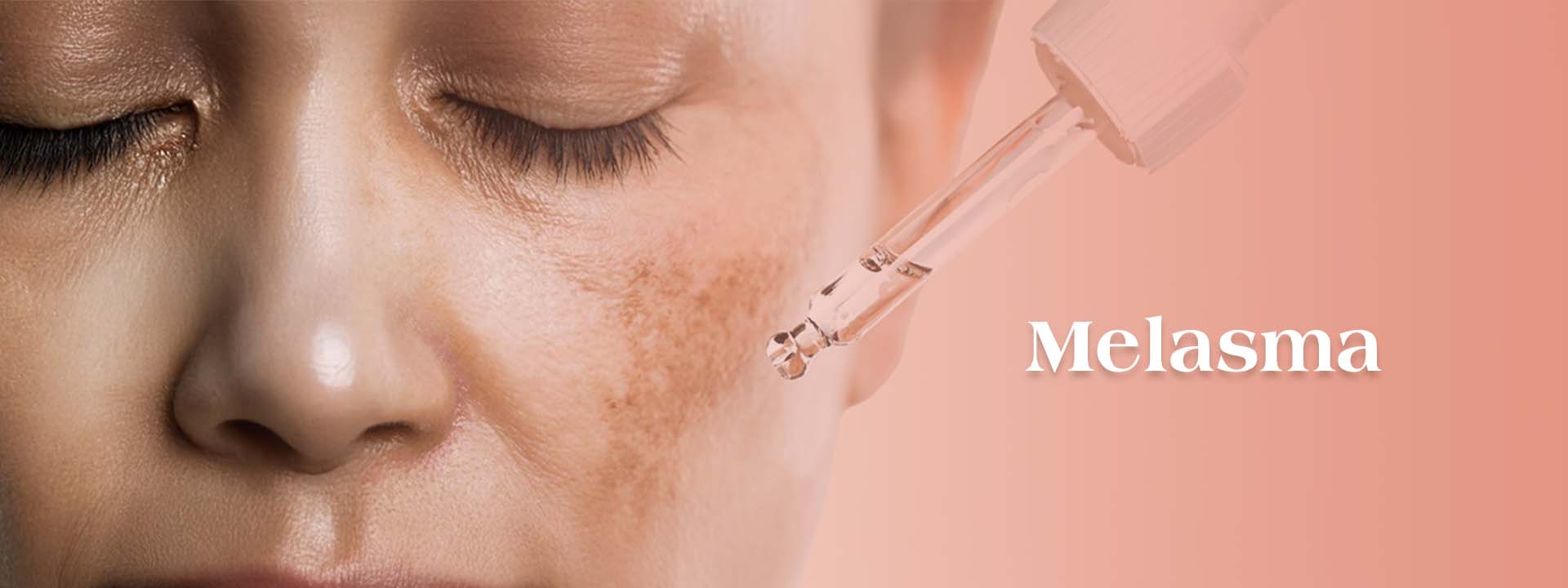 Melasma banner img