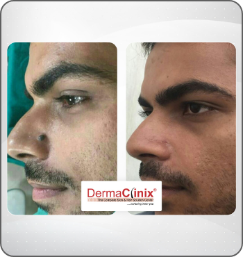 hair transplant results