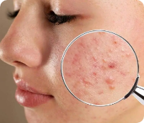 Acne Treatment