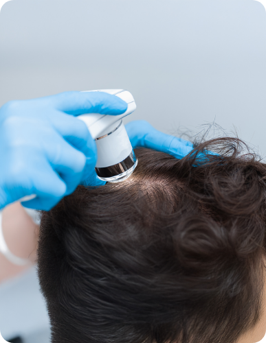 best hair transplant in delhi