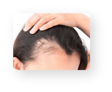 Alopecia Areata