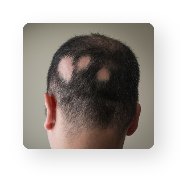 Alopecia Areata