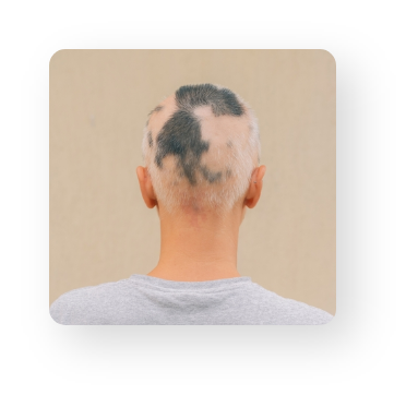Alopecia Areata