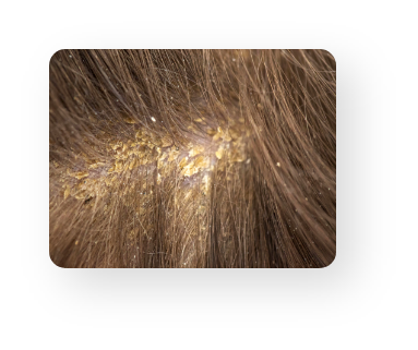 Alopecia Areata