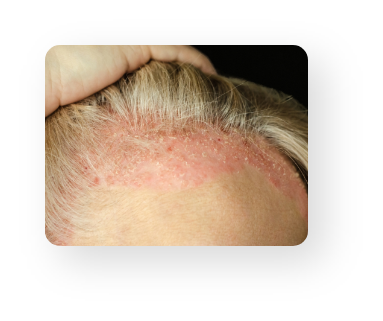 Alopecia Areata
