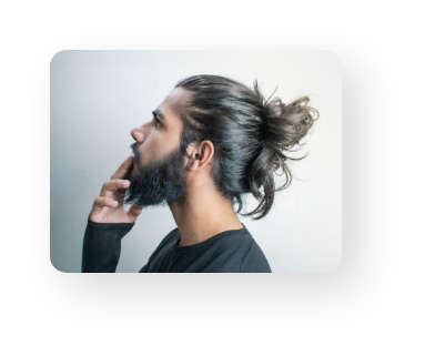 Alopecia Areata