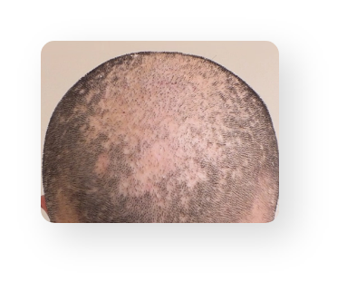 Alopecia Areata