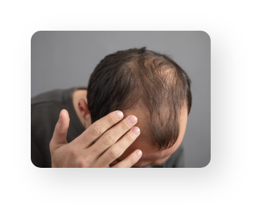 Alopecia Areata