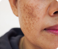 Skin Brightening
