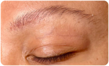 area-botox-section